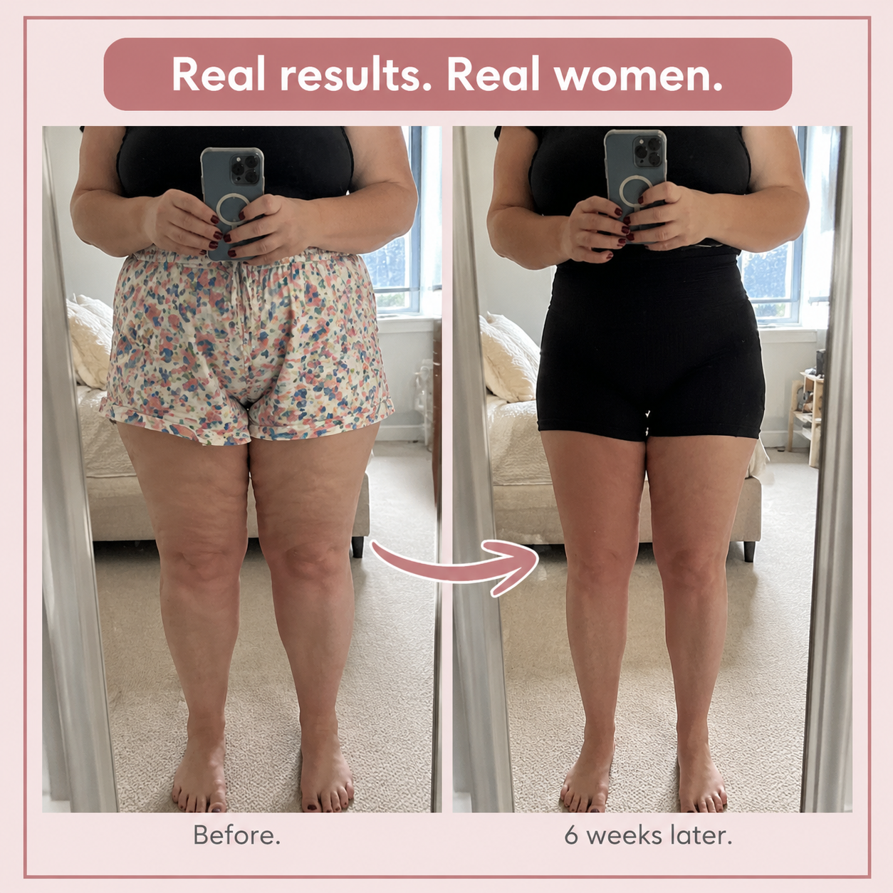 FitAva 3D High-Waist Legging for Lipoedema