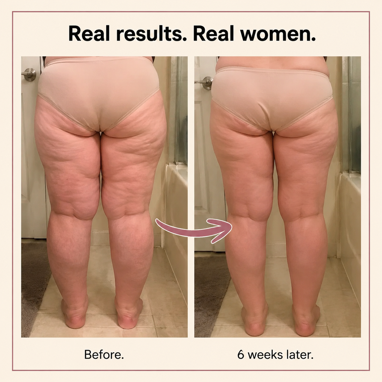 FitAva 3D High-Waist Legging for Lipoedema