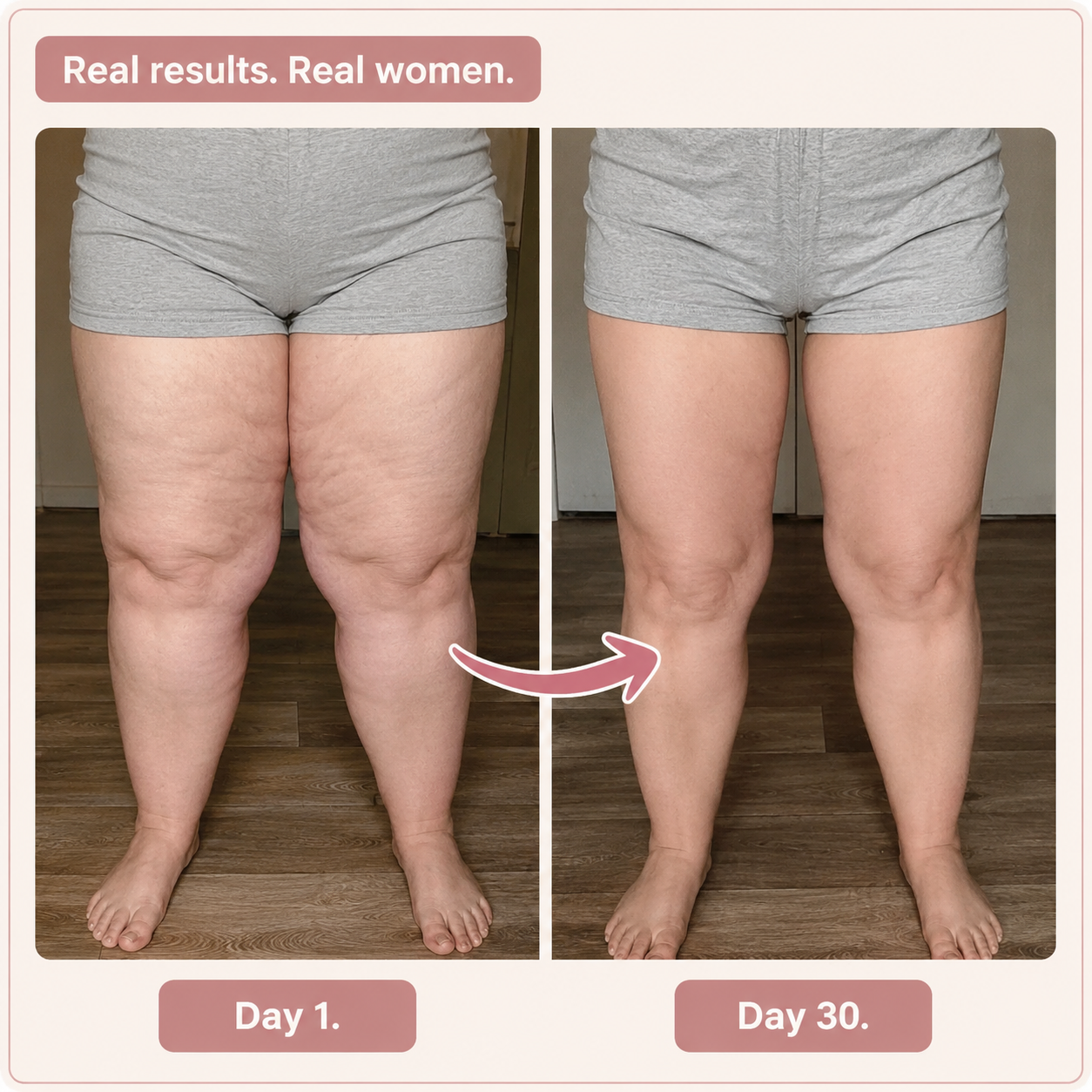 FitAva 3D High-Waist Legging for Lipoedema